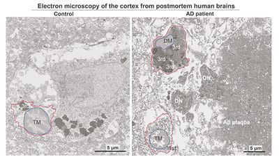 阿尔茨海默症致病关键细胞机制明确